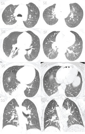 Case 5: Premortem axial chest computed tomography (CT) of the upper (A), mid (B), and inferior (C) thirds of the lungs obtained 2 days before death showing a few abnormalities, including a small peripheral and posterior ground-glass opacity in the lower right lobe (C), a small atelectasis in the posterior and medial aspects of the same lobe, and a right pleural effusion. Postmortem axial chest CT of the upper (E), mid (F), and inferior (G) thirds of the lungs obtained 16 h 13 min after death showing findings similar to premortem CT findings, except for a diffuse and subtle increase in attenuation of the lungs and thinning of the atelectasis in the right inferior lobe—changes probably because of the expired lungs during postmortem CT. The ground-glass opacity in the small right inferior lobe is not observed on postmortem CT, and the right pleural effusion is stable. Images D and H show pre- and postmortem coronal reformats, respectively. This patient died from liver transplant complications. Pre- and postmortem chest CT showing a normal lung parenchyma, indicating that she died with COVID-19, not from COVID-19.