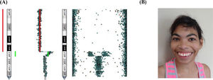 Representation of the deletion followed by a duplication in 5p, found in Patient 5, obtained with the software BlueFuse for Illumina's chromosomal microarray analysis (A) and a picture of the patient's face, at the age of 22-years and 5-months (B).