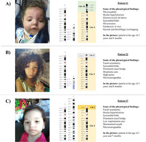 Pictures of patients' faces, followed (at the right side) by the chromosomal representation of the rearrangements observed with the phenotypical findings that were addressed individually in the discussion. (A) Patient 11 at the age of 2-years and 4-months, with a rearrangement between chromosomes 5 and 18, generating a phenotype compatible with 5p- syndrome and 18q duplication syndrome, (B) Patient 22 at the age of 3-years and 8-months, with a rearrangement between chromosomes 5 and Y, that led to an initial unexpected karyotype of 45,X, based on the normal male genitalia and clinical features that matched 5p- syndrome, and (C) Patient 27 at the age of 1-year and 7-months, with a rearrangement that generated a derivative chromosome 5, originated from 5p deletion and 2p duplication. All images for the chromosomal rearrangements were constructed using NCBI Genome Decoration Page.