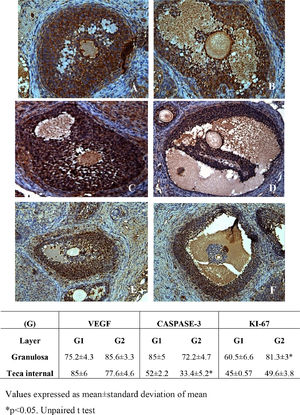 Photomicrographs of frozen-thawed rat ovarian autografts by immunohistochemistry for VEGF (A and B), apoptosis by Cleaved Caspase-3 (C and D) and cellular proliferation by Ki-67 (E and F) treated with culture medium (A, C and E) or adipose tissue-derived stem cells (B, D and F) (200 ×). (G) Immunohistochemical analyzes for angiogenesis (VEGF), apoptosis (Cleaved caspase-3) and cellular proliferation (Ki-67) in frozen-thawed rat autografts treated with culture medium (G1) or adipose tissue-derived stem cells (G2). The assessment was performed by counting the number of total cells and the positive cell staining in granulosa cells and theca internal layer of antral follicles. Values are expressed in percentage of positive area (arbitrary unity/mm2). *p < 0.05, Unpaired t-test.