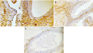 Phosphorylated Ezrin immunohistochemistry in the stroma of endometriosis lesions. (A) Score 3 (strong) in well-differentiated glandular endometriosis histological type (40 ×). (B) Score 2 (moderate) in well-differentiated glandular endometriosis histological type (40 ×). (C) Score 1 (weak) in well-differentiated endometriosis histological type (40 ×).