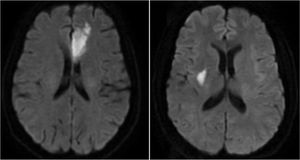 The acute infarctions of two patients of PSD on DWI. Left: A 63-year-old female, she was admitted because of right limb weakness and aphagia with NIHSS score 3. The brain MRI showed acute infarction in left frontal lobe. After hospitalization for 7 days, she was discharged with a NIHSS score 2. Three months later she had no obvious functional impairment but had a GDS score 9 and was identified to have PSD. Right: A 54-year-old male, he was admitted because of weakness and numbness of left limb with NIHSS score 3. The brain MRI showed acute lacunar infarction in right basal ganglia. During hospitalization he didn