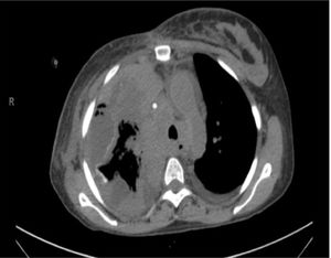 Empyema post-pleurodesis on chest CT scan. Caption: Chest CT scan (axial) after talc pleurodesis, showing a right malignant pleural effusion loculated, pleural calcification secondary to talc, pleural thickening, and intervening gas suggestive of empyema.