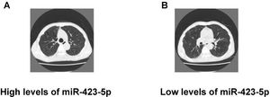 Relationship between plasma miR-423-5p expression and the chest tomography results in COPD patients. The chest tomography results of the COPD patients with the high levels of miR-423-5p (A) and low levels of miR-423-5p (B).