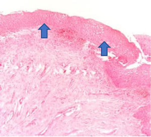 The atrophic epithelium seen in the anatomopathological analysis of vaginal biopsy before oxytocin (arrows). Photomicrographs obtained with an AXIO ZEISS microscope, AxioCam MRc5 system (100 ×  magnification, Hematoxylin–Eosin). Source: Author's archive (2021).