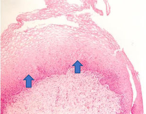 The increase in the thickness of the vaginal epithelium seen in the anatomopathological analysis of vaginal biopsy after oxytocin (arrows). Photomicrographs obtained with an AXIO ZEISS microscope, AxioCam MRc5 system (100 ×  magnification, Hematoxylin-Eosin). Source: Author's archive (2021).