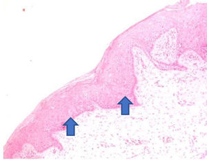 The atrophic epithelium seen in the anatomopathological analysis of vaginal biopsy before promestriene (arrows). Photomicrographs obtained with an AXIO ZEISS microscope, AxioCam MRc5 system (100 ×  magnification, Hematoxylin-Eosin). Source: Author's archive (2021).