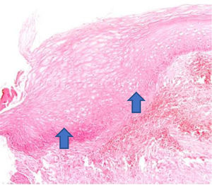 The increase in the thickness of the vaginal epithelium seen in the anatomopathological analysis of vaginal biopsy after promestriene (arrows). Photomicrographs obtained with an AXIO ZEISS microscope, AxioCam MRc5 system (100 ×  magnification, Hematoxylin-Eosin). Source: Author's archive (2021).