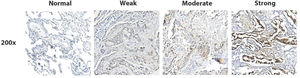 P4HA2 expression in the tissue ecosystem. (A, C, E) tSNE visualization shows P4HA2 expression in different clusters of normal lungs, LUAD, and LUAD brain metastasis tissues, respectively. (B, D, F) Difference in the P4HA2 expression between epithelial cells and fibroblasts of normal lung, LUAD, and LUAD brain metastasis tissues, respectively. P4HA2, Prolyl 4-Hydroxylase subunit Alpha-2; tSNE, t-distributed Stochastic Neighbor Embedding; LUAD, Lung Adenocarcinoma.