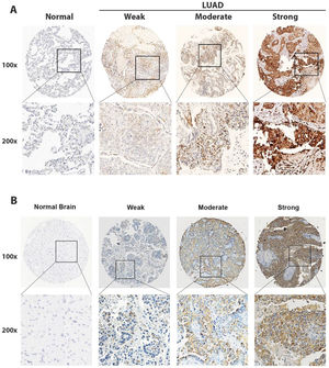 In situ detection of P4HA2 in LUAD and LUAD-BM cases. Representative IHC images of negative, low, moderate, and strong P4HA2 expressions (magnifications, 100 × and 400 ×) in LUAD (A) and LUAD-BM cases (B). P4HA2, Prolyl 4-Hydroxylase subunit Alpha-2; LUAD, Lung Adenocarcinoma; BM, Brain Metastasis; IHC, Immunohistochemistry.