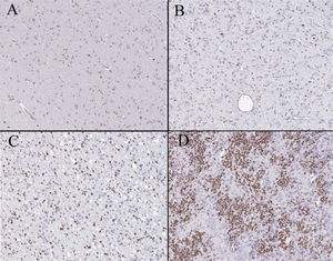 OLIG2 expression on immunohistochemistry. The intensity of OLIG2 is varied from 0 to 3 in Figure A to Figure D (magnification  × 400-fold).