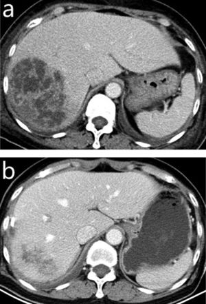 In a 56-year-old liver abscess male with diabetes mellitus, the contrast-enhanced portal-venous phase CT images show the preoperative liver abscess cavity (a), and the obvious shrinkage of it (b) and no pus can be drained 32 days after the CT-guided interventional therapy.