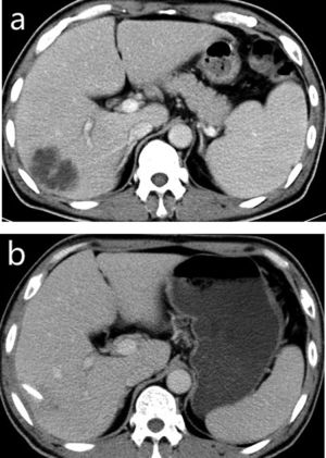 In a 53-year-old liver abscess male without diabetes mellitus, the contrast-enhanced portal-venous phase CT images depict the preoperative liver abscess cavity (a) and the shrinkage of it (b), and no pus drainage can be found 18 days after the CT-guided interventional therapy.