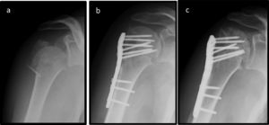 Radiographs showing initial fracture (a); one day after the surgery (b); six months after the surgery with radiological evidence of HHO (c).