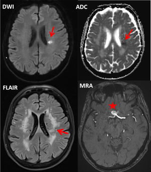 Cerebral MRI of the index patient showing an acute ischemic lesion periventricularly on the left side (arrows), leucoaraiosis, and an aneurysm of the communicant anterior artery (asterik) with 10 mm in diameter (DWI, Diffusion Weighted Imaging; ADC, Apparent Diffusion Coefficient; FLAIR, Fluid Attenuated Inversion Recovery; MRA, MR-Angiography).