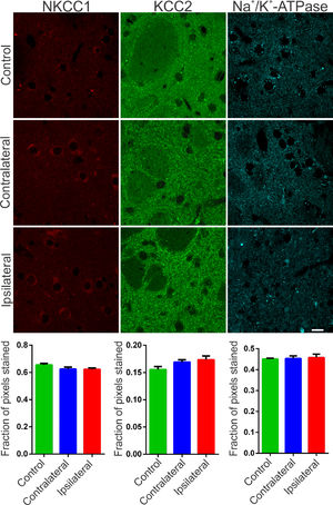 Representative photomicrographs of immunoreactivity to NKCC1 (red), KCC2 (green) and Na+/K+-ATPase (cyan blue) of Wistar striatal region after 6-OHDA injection – ipsilateral (lesional region) and contralateral – and sections after saline injection (control animals). For NKCC1 immunostaining, sparce immunoreactivity is observed and also around large cell bodies, characteristic of spiny neurons of the mature striatal nucleus. For KCC2, a difuse staining is observed and, mainly, with a puncta pattern throughout the striatum. Immunofluorescent puncta is also typical of the α1 subunit of the Na+/K+ -ATPase enzyme staining. No significant variation was observed between the regions injured with 6-OHDA and other regions of the striatum, as can be seen in the representative images and confirmed by optical densitometry quantification and comparative analysis. White bar indicates 10 µm.