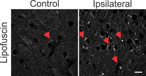 Photomicrographs with omission of primary antibodies in striatal regions after 6-OHDA injury and in control animals. Observe the punctuated aspect of cytoplasmic depositions similar to the autofluorescent lipofuscin pigment (red arrows). The lesional region shows more intense punctuated areas when compared to the same region without the 6-OHDA lesion, in the control sections. There is also a greater number of cells with a small cell body, similar to glial cells in the lesional region. White bar indicates 10 µm.