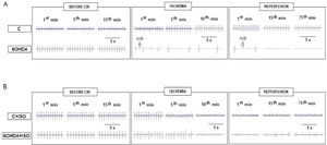 Typical ECG records showing the VA and AVB induced by CIR in 6-OHDA and control rats. The baseline values of heart rate recorded before CIR (in rest) showed no significant differences between 6-OHDA and control (C) groups. (A) With less than 1 min after cardiac ischemia, arrhythmias were observed in 6-OHDA, but not in C rats. Arrhythmias tended to worsen over time in the 6-OHDA group, which evolved to AVB (see ECG obtained in 1st, 5th and 10th min ischemia, and 1st and 75th min reperfusion) in 92% (11/12) of these rats. In contrast, the incidence of AVB was lower in C rats. (B) Incidence of VA, AVB and LET was significantly reduced by treatment with ISO (0.5 mg/kg, i.v., before ischemia) in 6-OHDA + ISO and C + ISO groups.