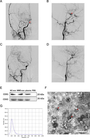 Digital subtraction angiography (DSA) images and characterization of exosomes in the plasma of moyamoya disease patients. (A‒B) Digital Subtraction Angiography (DSA) images of moyamoya disease patients. The arrows on the pictures show the narrowing/stenosis of the carotid artery that causes moyamoya disease. (C‒D) Digital subtraction angiography (DSA) images of nonmoyamoya disease patients. A and C are standard anterior positions, B, D are standard lateral positions. (E) The protein levels of CD81 and CD63 in exosomes were analysed by western blotting. (F) Transmission electron microscopy image of a mixture of NC and MMD exosomes. The arrows on the pictures show exosomes. Scale bar, 100 nm. (G) Size distribution of exosomes determined by nanoparticle tracking analysis. NC-exo, Exosomes from Non-MMD patients; MMD-exo, Exosomes from MMD patients.