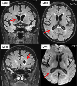 Cerebral MRI with contrast medium on hospital day 2 showing ependymal enhancement.