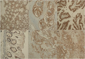 (a) Weak cytoplasmic Akt-staining in a normal colon mucosa (×100, IHC). (b and c) Intense, diffuse immunopositivity for Akt in the colon adenocarcinoma (×100 and ×200, respectively). (d) Weak cytoplasmic Akt-staining in the normal colon mucosa (×200, IHC). (e) Intense and diffuse cytoplasmic Akt-staining in the peritoneal carcinomatosis (×100, IHC). (f) Cytoplasmic Akt-staining in the liver metastasis (×200).