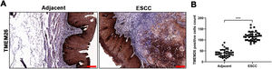 Elevated TMEM26 expression in ESCC. (A) Representative images of immunohistochemical staining for TMEM26 were conducted for slices from the ESCC tumor and control tissues from the same patient. (B) A higher number of TMEM26-positive cells were quantified in the ESCC tumor tissues compared with the control tissues from the same patient. Data are presented as mean ± S.D., n = 40, ***p < 0.001.