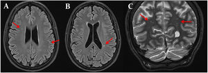 Multimodal cerebral MRI at the age of 32 shows mild global atrophy and multiple T2-yperintense spots within the white matter bilaterally (panels A, B, and C).