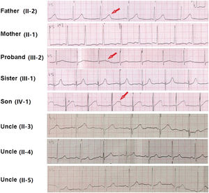 ECG of the proband and family members in V5 or V3 lead. Different T-wave morphologies were observed. Individuals with clinical diagnosed long QT2 syndrome including the proband (III-2), and her farther (II-2) and her son (IV-1) showed bifid or notched T-wave in ECG, pointed by red arrow.