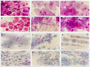 Microscopic observation of the vaginal microbiota (Gram stain 400 to 1000×) and maturation of the vaginal epithelium (Papanicolaou 400×). Vaginal microbiota in the control group: (A) day 0, (B) day 90; in the vaginal estrogen group: (C) day 0, (D) days 90; and in the MAFRF group: (E) day 0, (F) day 90. Vaginal epithelium maturation in the control group: (G) group day 0, (H) day 90; in the vaginal estrogen group: (I) day 0, (J) day 90; and in the MAFRF group: (K) day 0, (L) day 90.