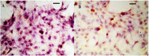 IHC analysis of VEGF in hyperplastic scar tissue. (A) Control group; (B) Observation group after treatment.