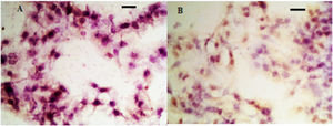 IHC analysis of TGF-β in hyperplastic scar tissue. (A) Control group; (B) Observation group after treatment.
