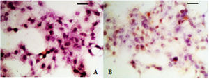 IHC analysis of PDGF in hyperplastic scar tissue. (A) Control group; (B) Observation group after treatment.