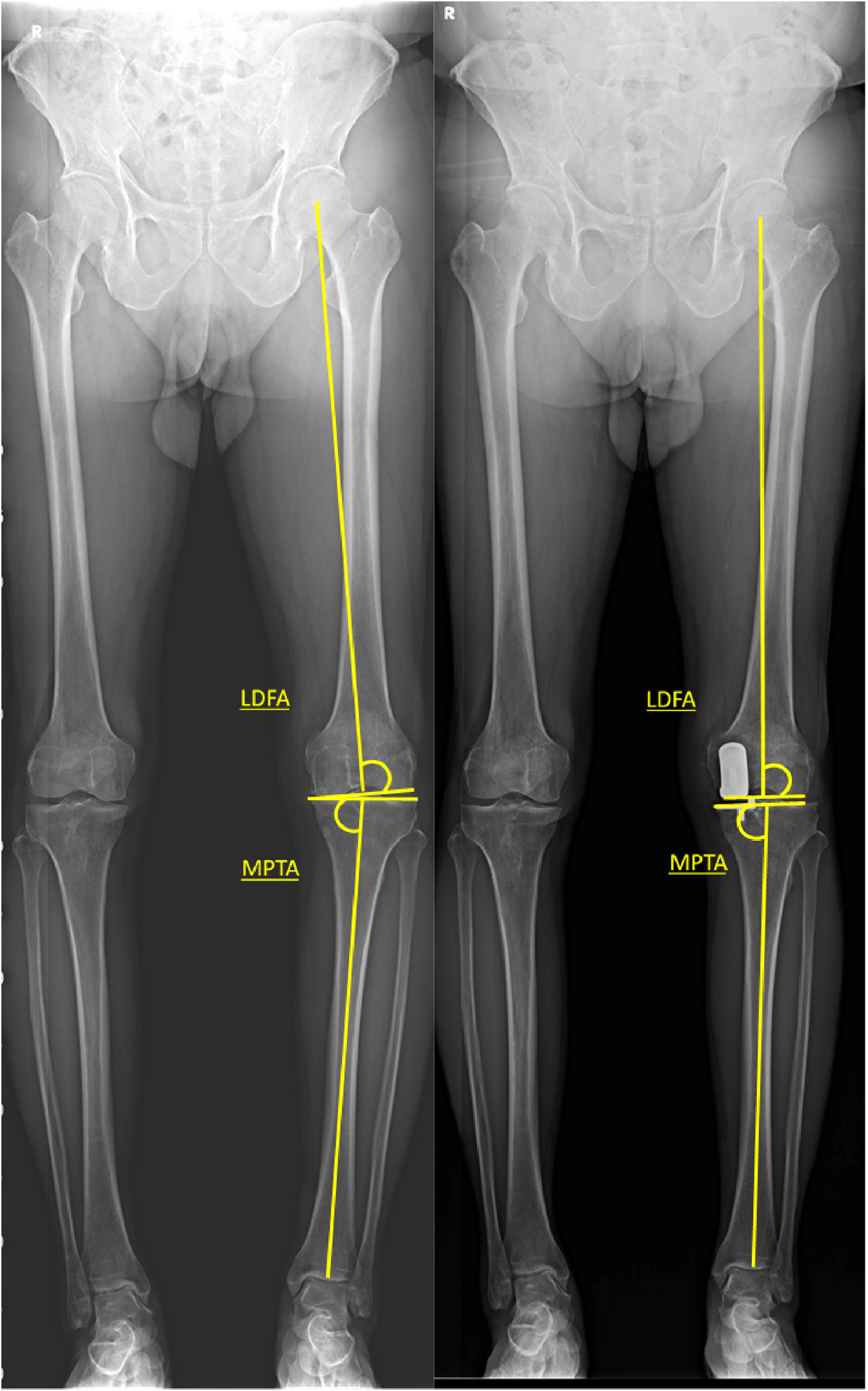 Analysis Of Correlation Between Medial Joint Line Change And Lower Limb analysis-of-correlation-between-medial-joint-line-change-and-lower-limb