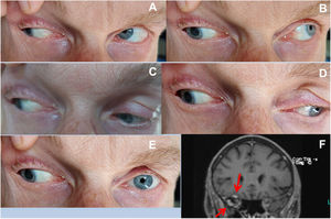 Right third cranial nerve palsy in the index patient (A: Gaze to the top right; B: Gaze to the top left; C: Gaze to the bottom right; D: Gaze to the bottom left, E: Gaze straight forward, F: Coronary T1-weighted image with contrast showing enhancement of the right superior lateral rectus muscles).