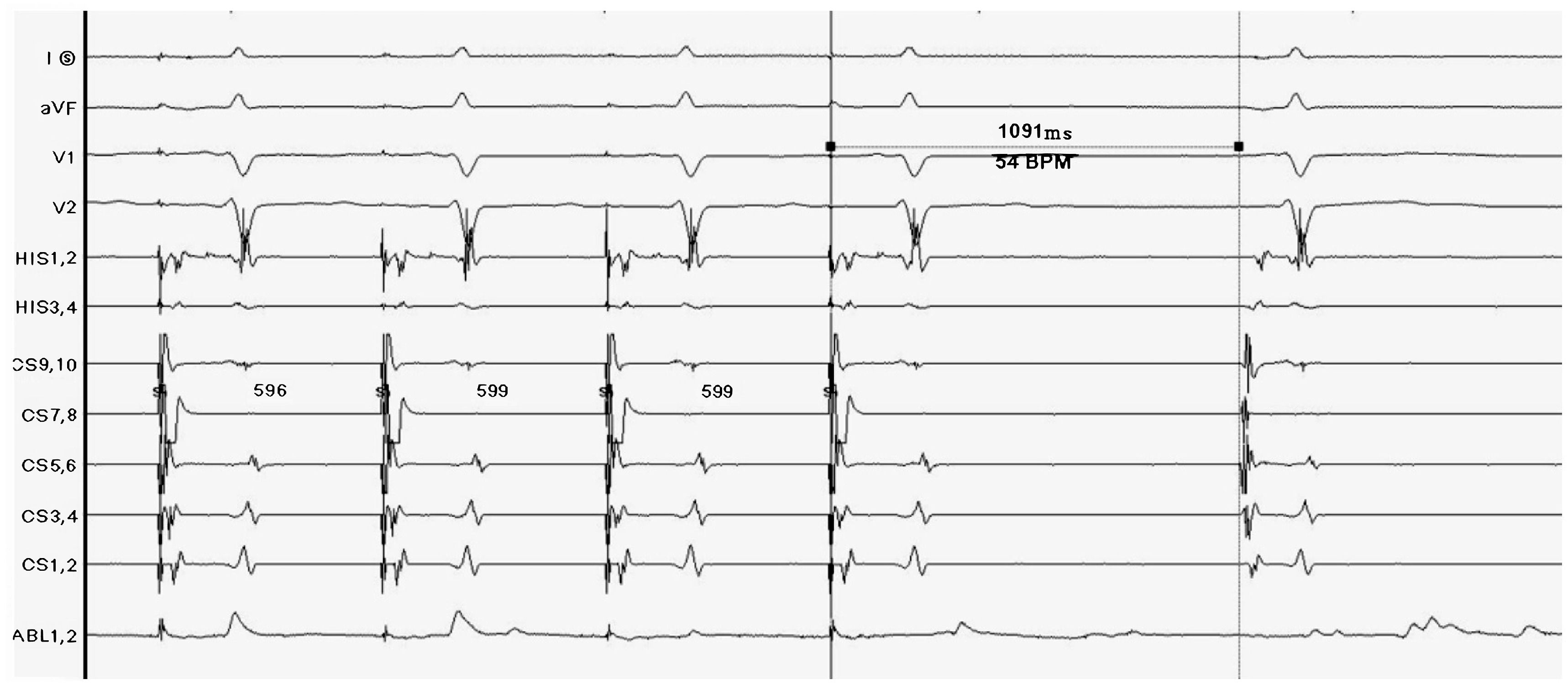 Ablation of myocardial autonomic ganglion plexus in the treatment of ...