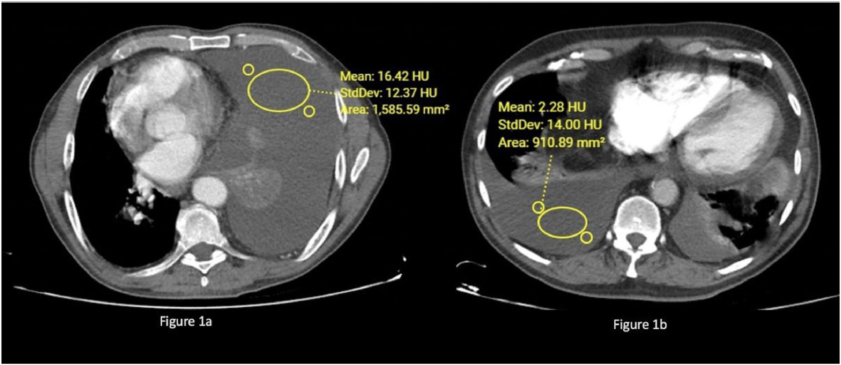 Fluid Ct Microscope Computed tomography attenuation in differential diagnosis of ...