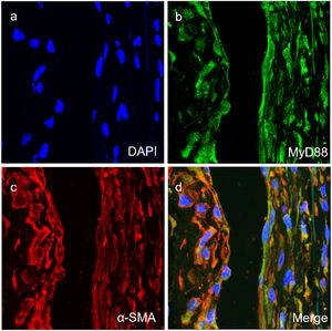 Co-expression of MyD88 with SMA (a‒d) in the vascular smooth muscle cells of vascular tissues of TAO group (magnification × 400).