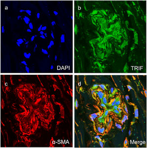 Co-expression of TRIF with SMA (a‒d) in the vascular smooth muscle cells of vascular tissues of TAO group (magnification × 400).