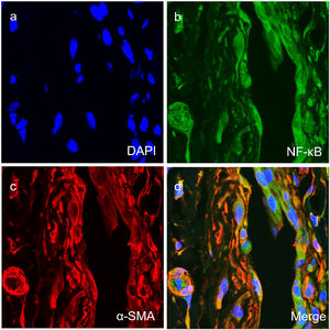Co-expression of NF-κB with SMA (a‒d) in the vascular smooth muscle cells of vascular tissues of TAO group (× 400).