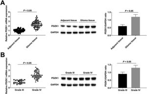 Up-regulated expression of PDZK1 in cancer tissues of HGG patients. (A‒B) RT-qPCR and Western blot detection of PDZK1 expression in HGG patients.