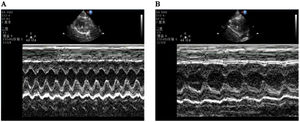 CIH-induced systolic dysfunction of the left ventricle. Echocardiographic images of rats in the NC group (A) and CIH group (B).