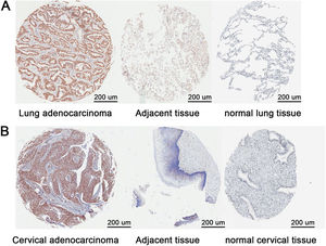 RBBP4 was overexpressed in lung and cervical adenocarcinoma clinical specimens. (A‒B) Tissue microarrays were used to study RBBP4 expression in clinical specimens. Scale bar is 200 μm.