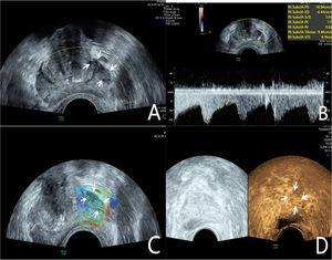 A 76-year-old patient had a total PSA of 14.3 ng/mL. Multiparameter US started with conventional transrectal ultrasound, and the lesion was a hypoechoic nodule at the junction of the inner and outer glands in the prostate’s left lobe (A, arrow). The lesion appeared on CDU with rich blood flow in the arterial spectrum (B, arrow). The operator used the endocavitary transducer to alternate between compressing and decompressing the lesion, which appeared mostly blue on TRTE (C, arrow). A hypoechoic nodule appeared on CEUS as a hypervascular nodule with a “fast in, fast out” enhancement pattern (D, arrow). Histopathology showed that the prostate lesions were clinically significant and Gleason 4 + 3 PCa.