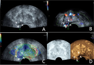 The lesion was a hypoechoic nodule in the outer glands of the prostate’s right lobe (A, arrow). The lesion appeared on CDU with rich blood flow (B). The operator used the endocavitary transducer to alternate between compressing and decompressing the lesion, which appeared mostly blue on TRTE (C). A hypoechoic nodule appeared on CEUS as a hypervascular nodule with hyperenhancing pattern (D).