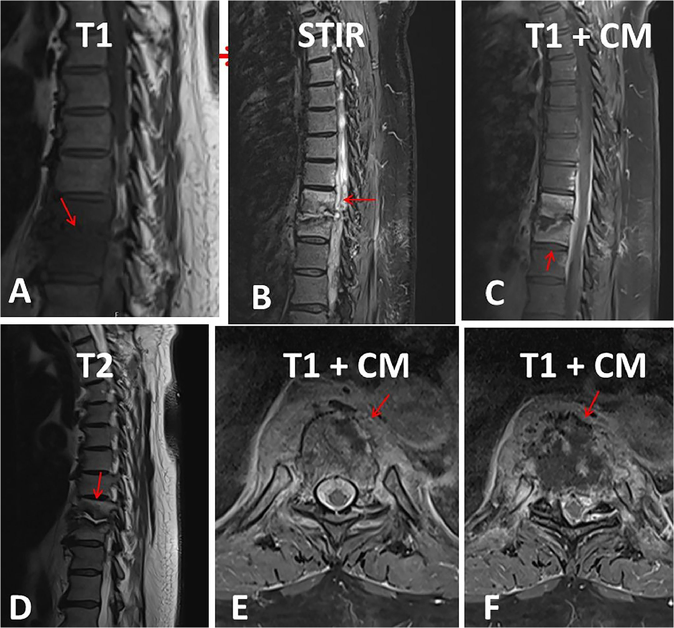 Aseptic thoracic spondylodiscitis (pseudo discitis) in a septuagenarian ...