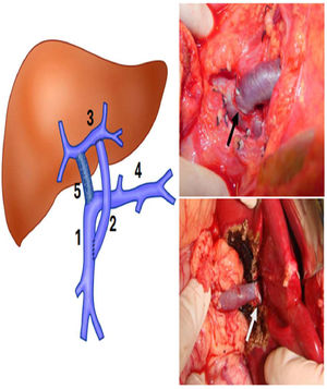 Left, schematic drawing showing MRS. (1) Superior mesenteric vein; (2) Venous graft; (3) Left portal vein in the Rex space; (4) Splenic vein; (5) Portal vein occluded by thrombosis. Right, on the top ‒ anastomosis between the venous graft and the superior mesenteric vein (black arrow). The white arrow indicates the anastomosis between the venous graft and left portal vein in the Rex recessus.