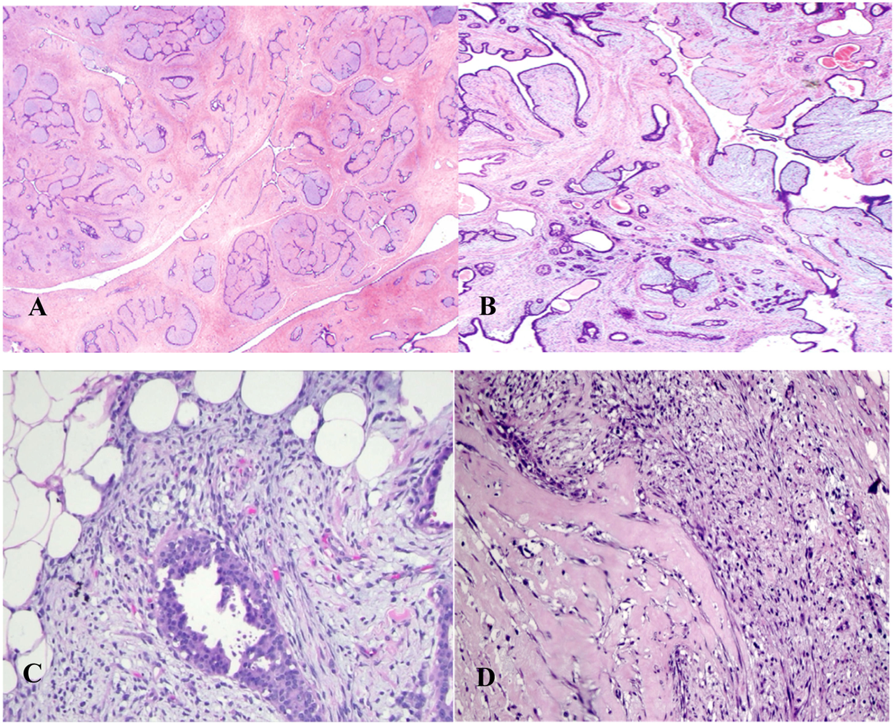 Phylloid Phyllodes tumors of the breast: A comprehensive review of diagnosis ...