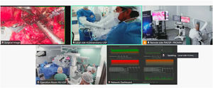 Integrated real-time monitoring display at the remote site (PROMIN-FMUSP) during a clinical telesurgery. The unified screen combined live video from cameras within the remote console room (FMUSP), live video from cameras in the operating room at Hospital Universitário da Universidade de São Paulo (HU-USP) showing the robotic unit and bedside team, the live endoscopic view from the robot displaying the surgical field, and a connectivity panel reporting network status. This consolidated layout supported continuous situational awareness across both sites, direct visualization of the ongoing procedure, and uninterrupted monitoring of network performance throughout each procedure.