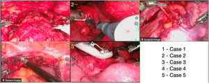 Intraoperative endoscopic snapshots from the five consecutive clinical telesurgeries. Anonymized still frames captured from the surgical console video output during each procedure; panel numbers correspond to case numbers. (1) Radical prostatectomy. (2) Retropharyngeal lipoma resection. (3) Left upper lobe pulmonary segmentectomy. (4) Hysterectomy with bilateral oophorectomy. (5) Resection of thoracic neoplasm.