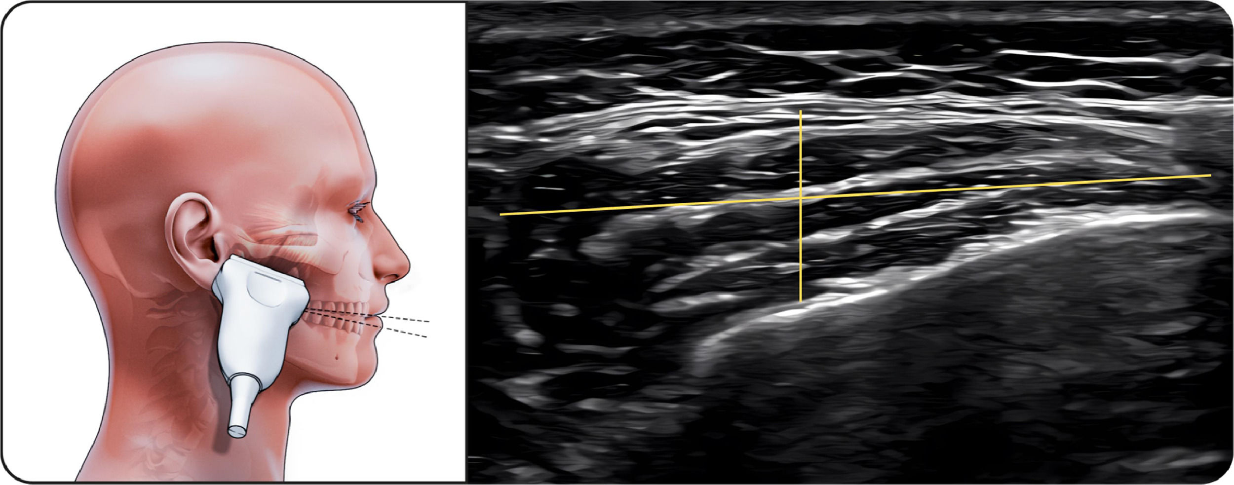 Ultrasound examination of asymmetry in temporomandibular disorders ...